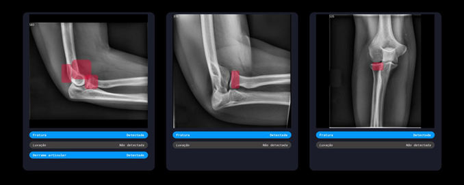 Inteligência Artificial para Detecção de Fraturas
