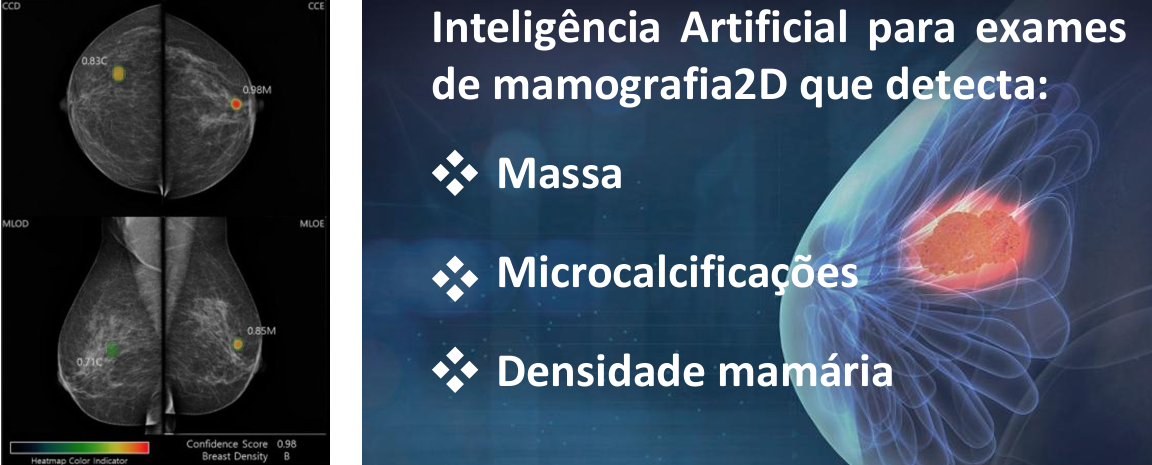 Inteligência Artificial para Mamografia